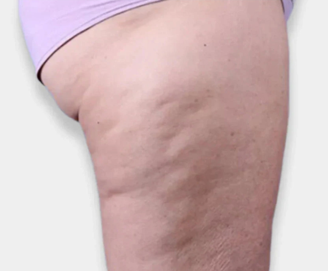 How to Effectively Reduce the Appearance of Cellulit